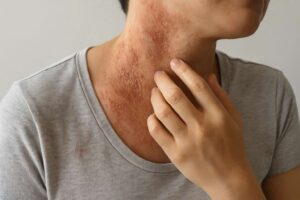 dermatitis atopica