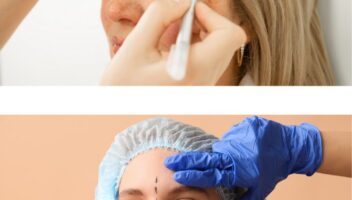 Upper/Lower Blepharoplasty (Eyelid surgery)