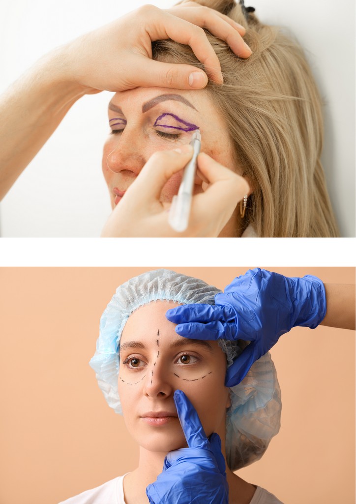 Upper/Lower Blepharoplasty (Eyelid surgery)