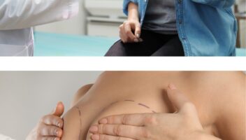 Breast Augmentation