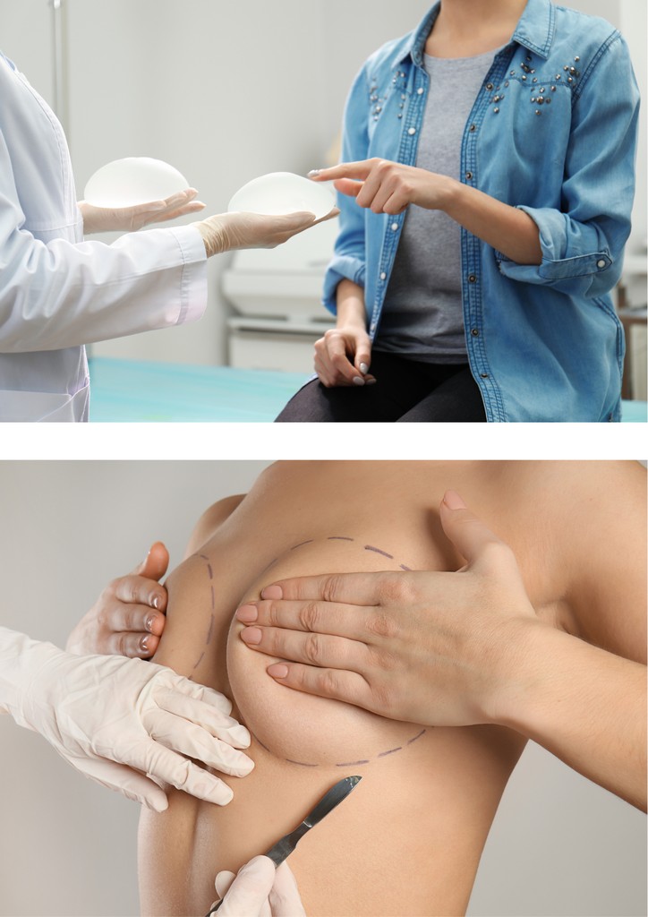 Breast Augmentation