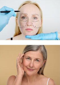 Facelift
