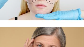Facelift