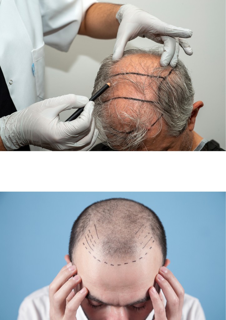 Hair Transplant