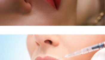 Lip Filler