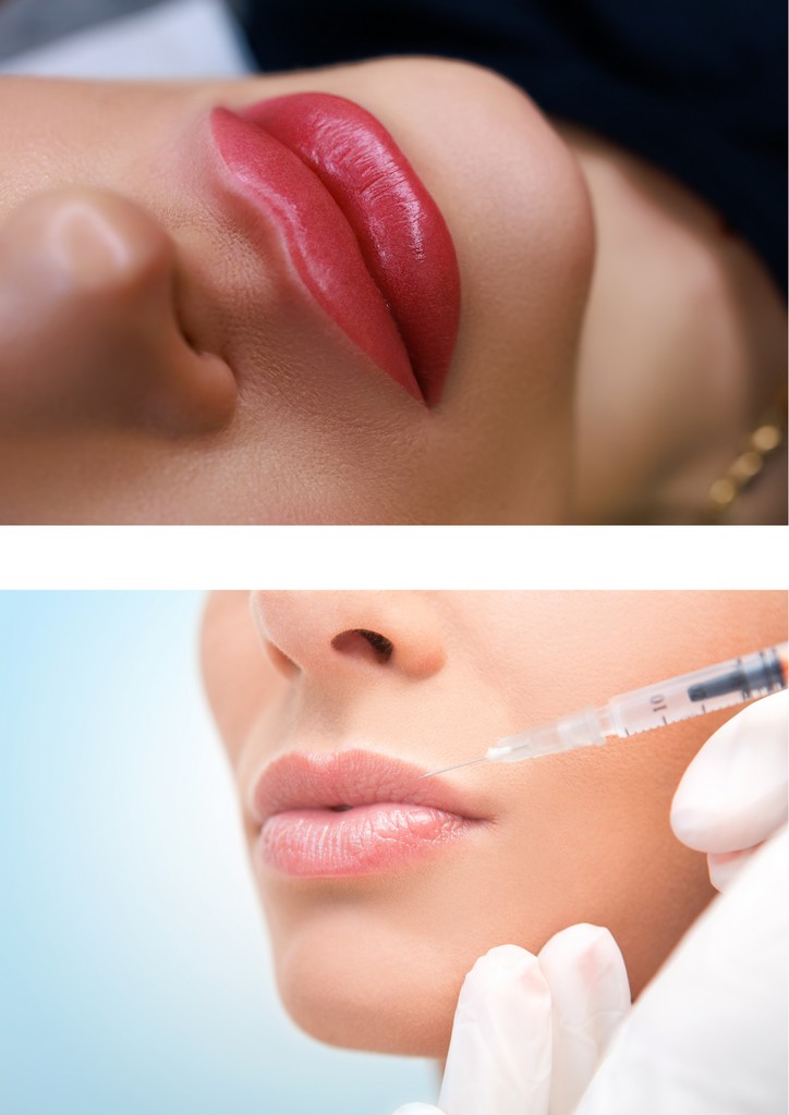 Lip Filler
