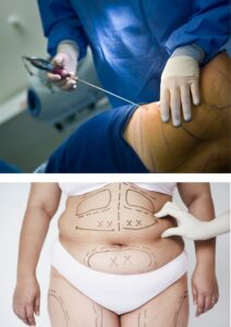 Liposuction (per area)