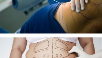 Liposuction (per area)