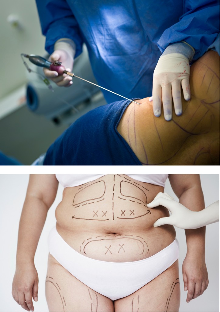 Liposuction (per area)