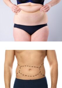 Tummy tuck