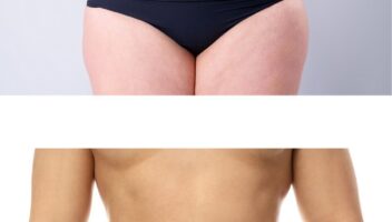 Tummy tuck
