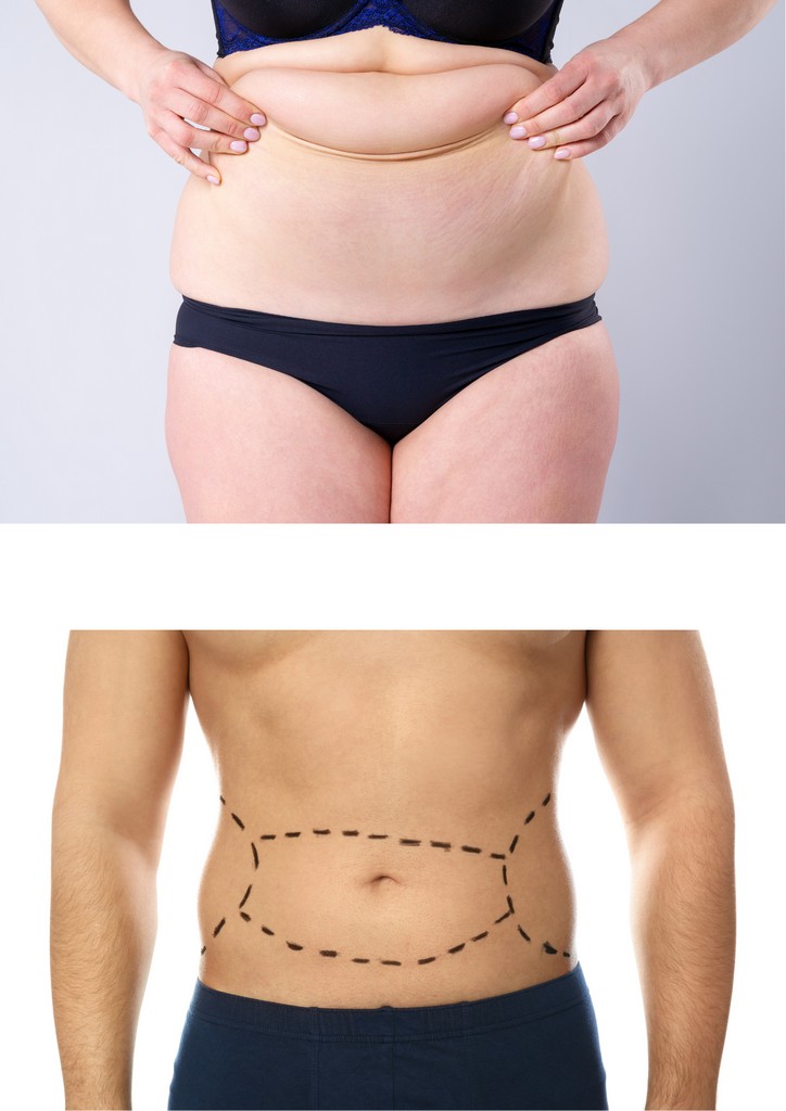 Tummy tuck